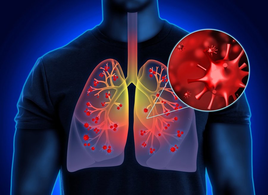 Plaučių uždegimas (nuotr. Shutterstock.com)