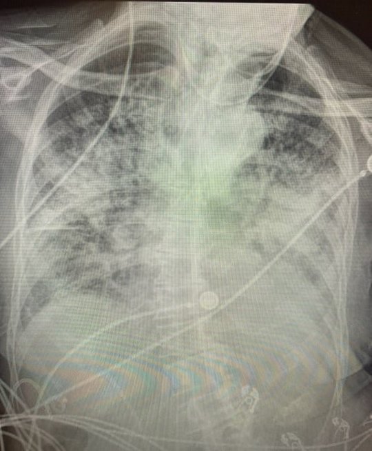 Koronavirusu persirgusio paciento plaučiai 