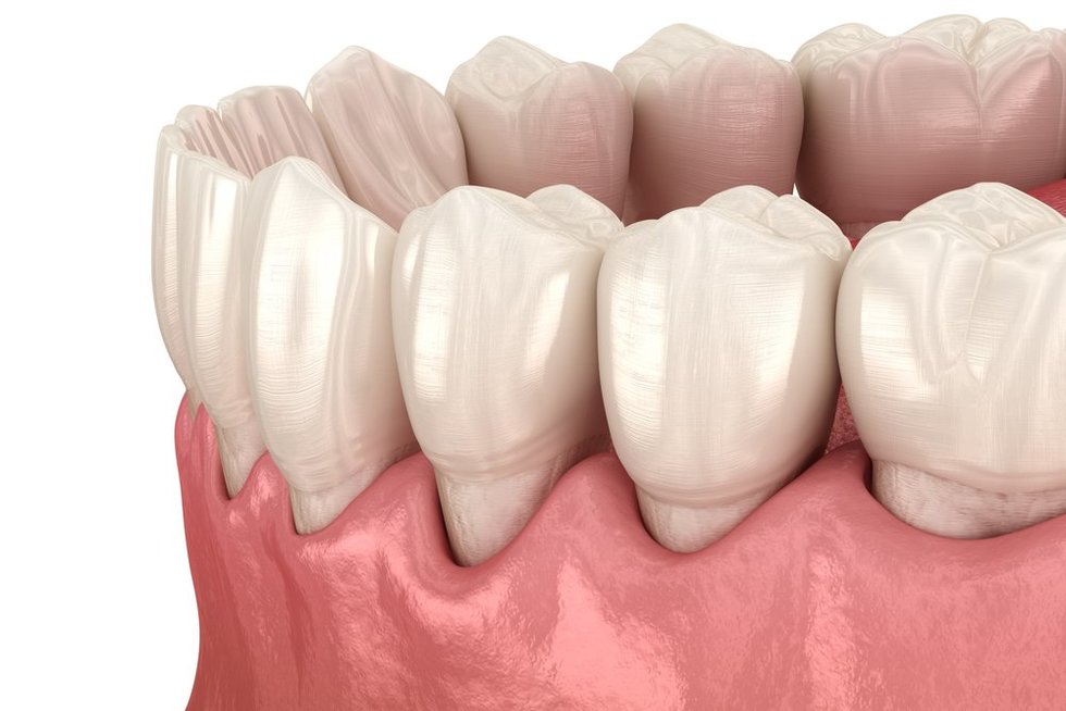 Dažniausia dantų netekimo priežastis: dėl šios ligos kreipiasi vis jaunesni pacientai (nuotr. Shutterstock.com)