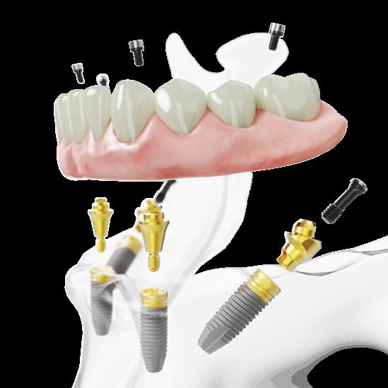 Naudojant All-on-4&reg; gydymo metodiką visi vieno žandikaulio dantys atkuriami ant 4 implantų / &bdquo;Nobel Biocare&ldquo; nuotr. 