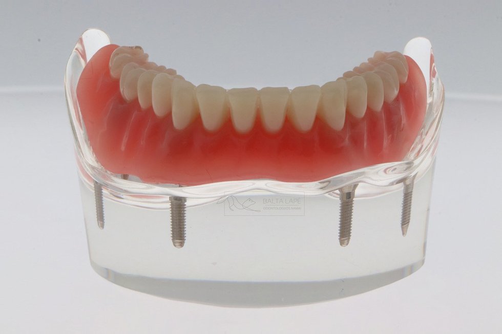 Dantų implantavimas: odontologė išsklaidė populiariausius mitus 