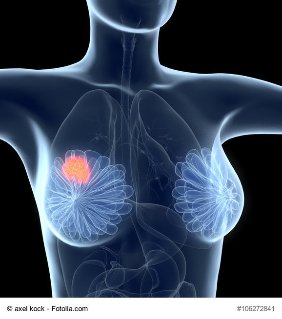 Krūties vėžys (nuotr. Fotolia.com)